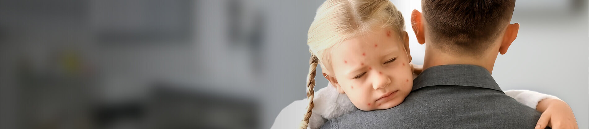 Chicken Pox